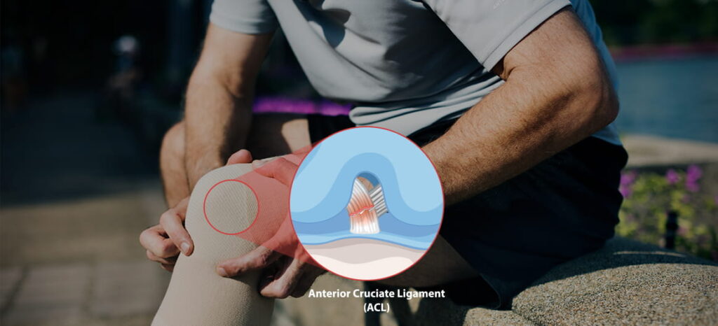 ACL Tear: Symptoms, Grades, and When Surgery Is Necessary
