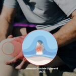 ACL Tear: Symptoms, Grades, and When Surgery Is Necessary